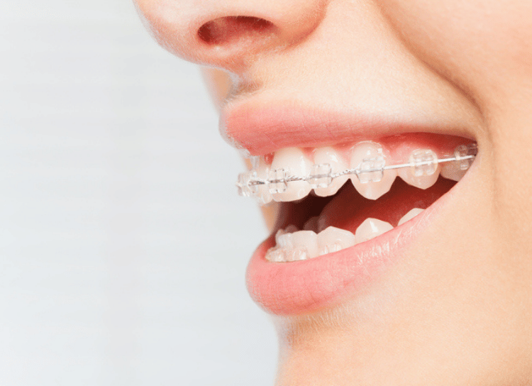 Ceramic Braces