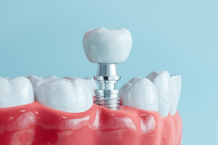Dental Implant