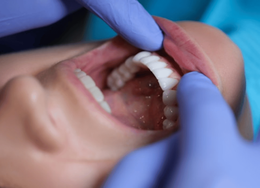 Finalizing veneer treatment