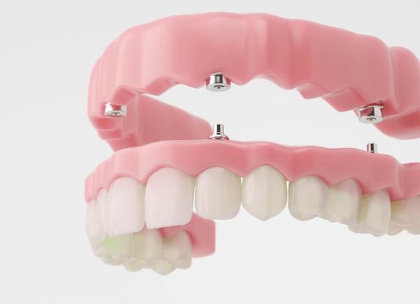 implant dentures
