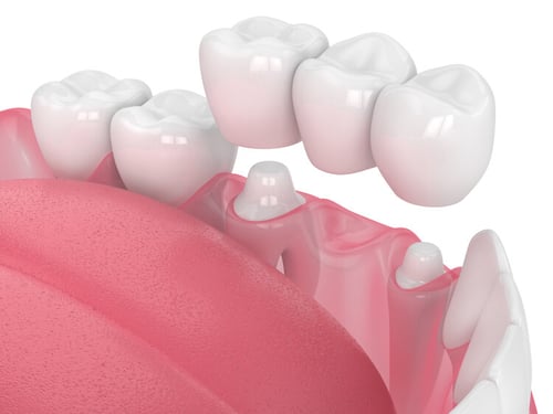 Post-Care Instructions for Temporary Crowns and Bridges