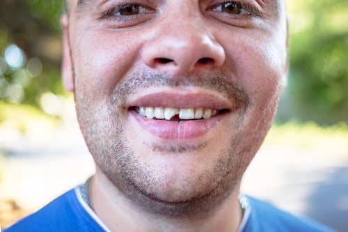 Why Spend Money on Chipped Tooth Repair?