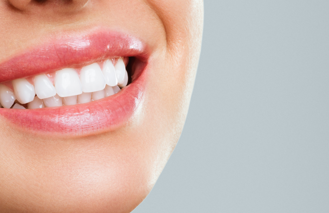 Teeth Whitening