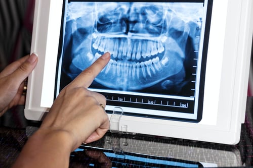 Understanding the Importance of Dental X-Rays in Maintaining Oral Health