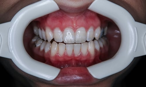 Why Are My Gums Swollen? Six Possible Reasons and What to Do