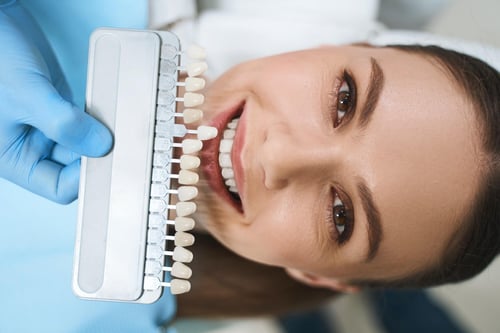 Everything You Want to Know About Veneers