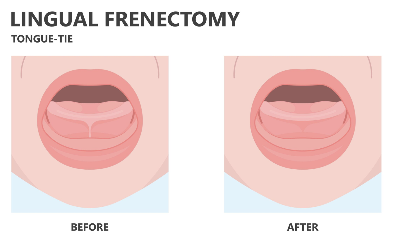Lingual Frenectomy