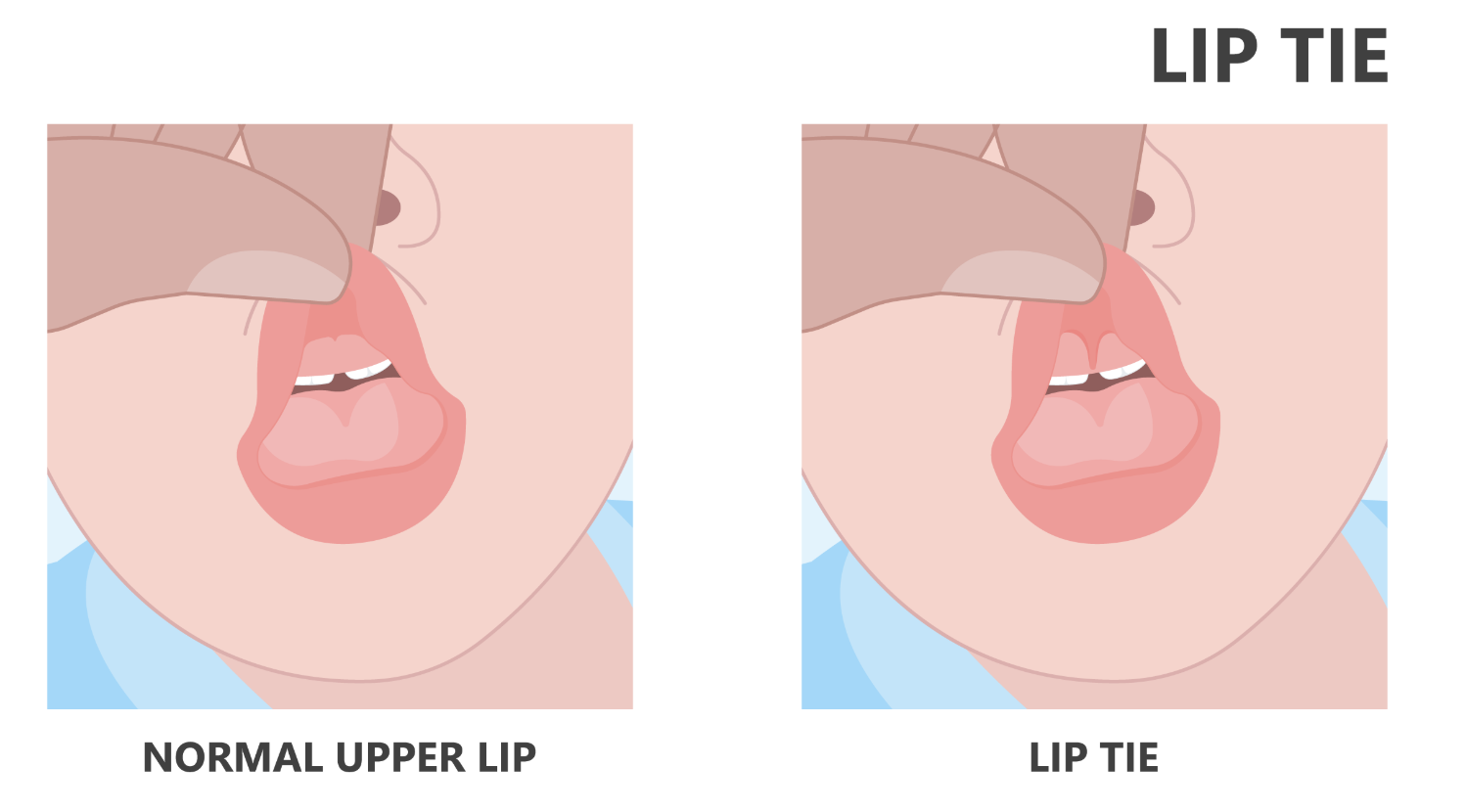 Lip Tie
