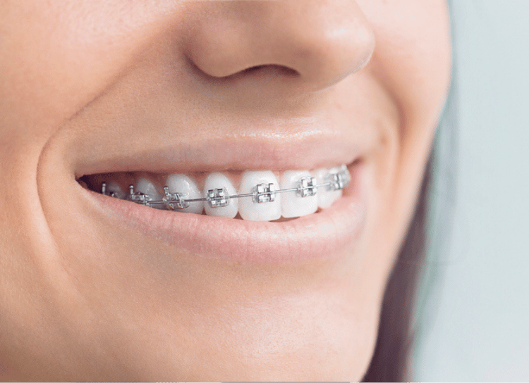 Normal Traditional Braces