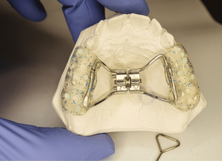 Palate Expander