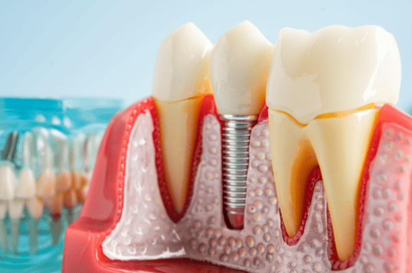 Single Tooth Implant
