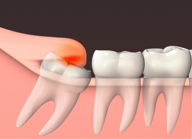 Soft Tissue Impaction