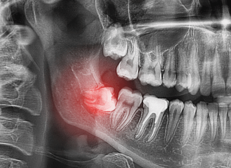 Wisdom teeth removal 3