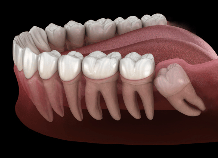 Wisdom teeth removal 2