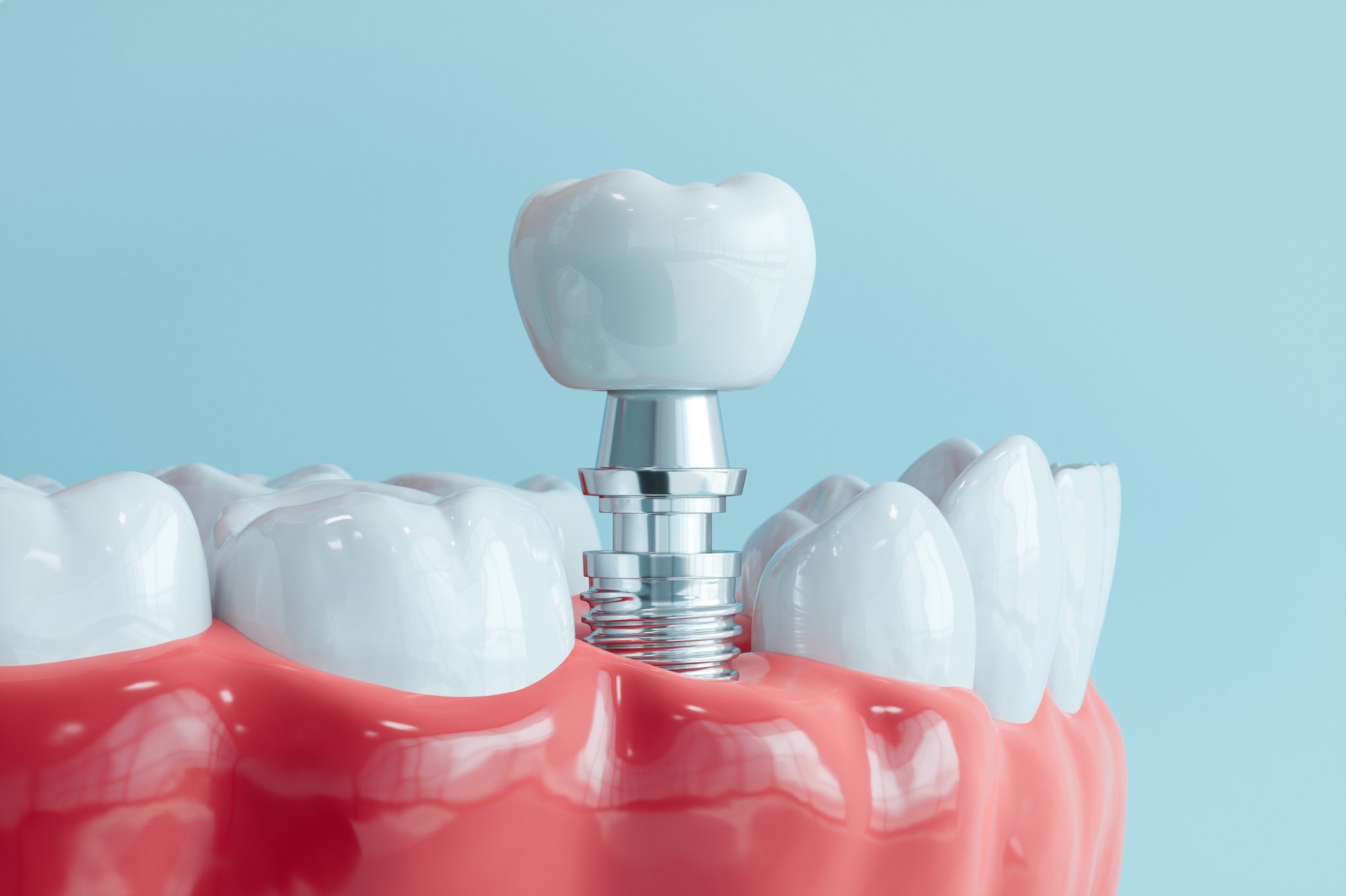 Close-up of dental implant restoration in a dental clinic