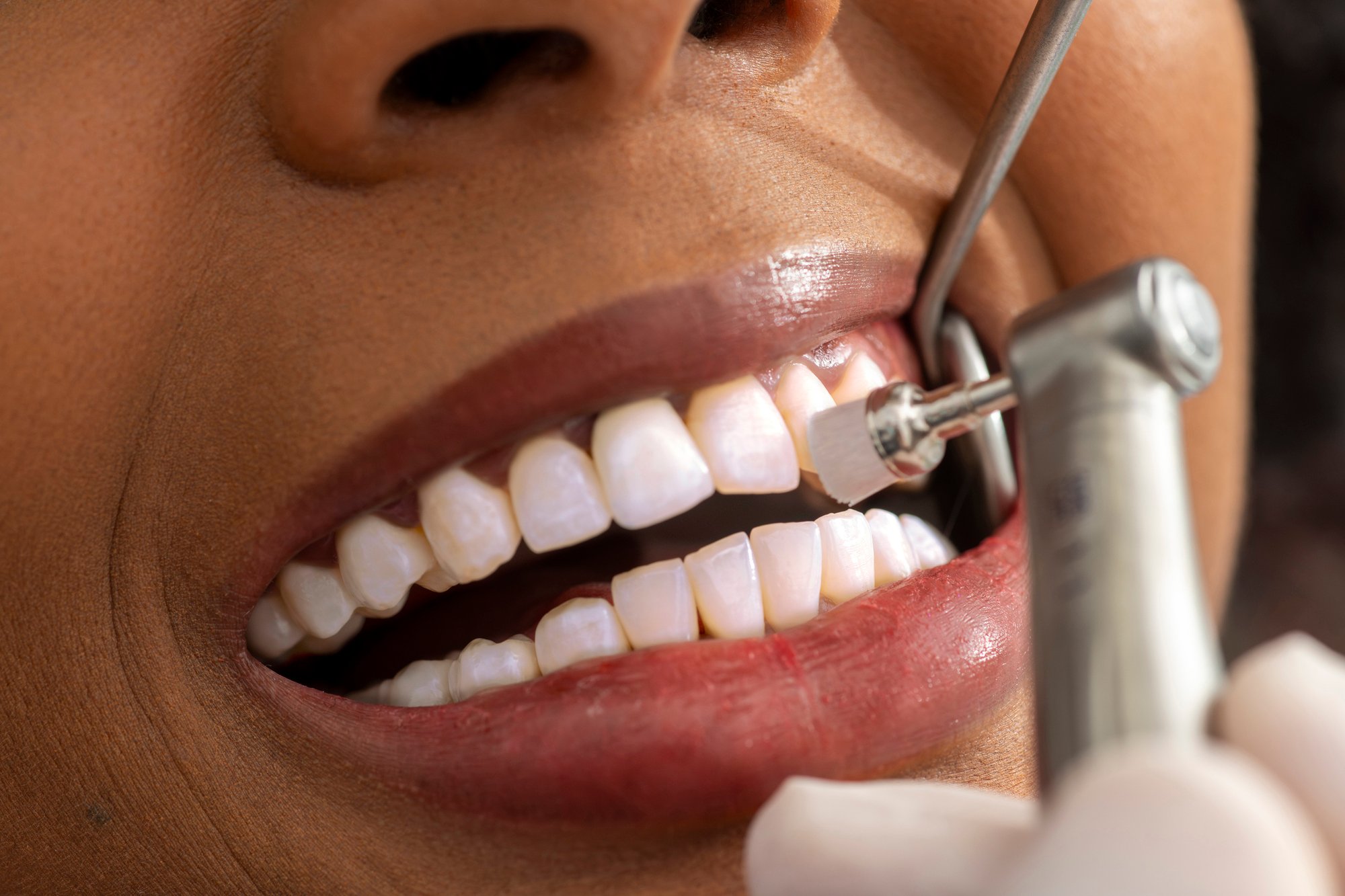 Professional teeth whitening treatment at a dental clinic