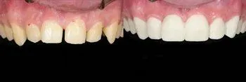 Veneers1_beforeafter1