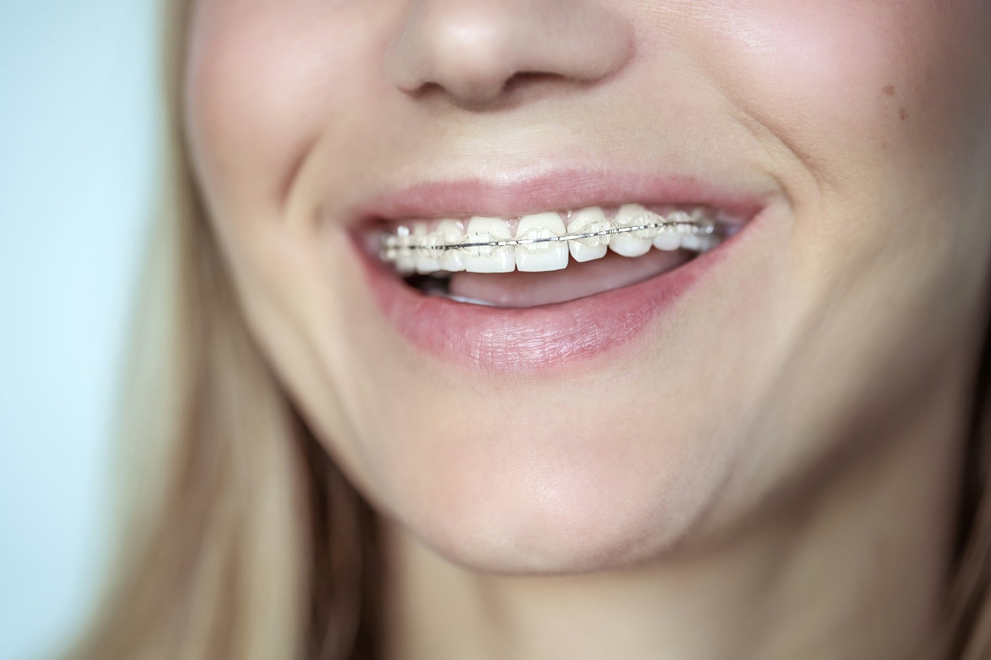 Read more about the article Clear Ceramic Braces