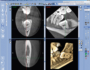 Read more about the article Cone Beam Collimated Tomography