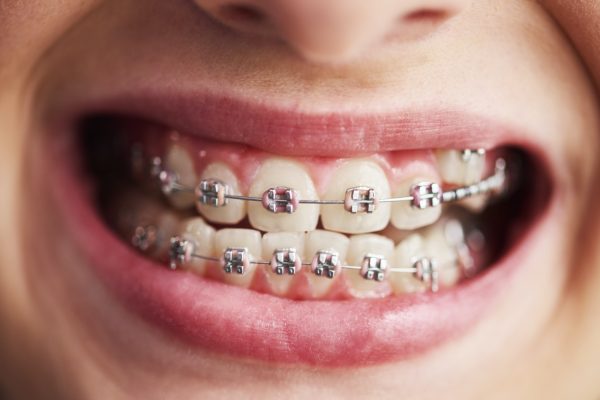 Shot of child's teeth with braces